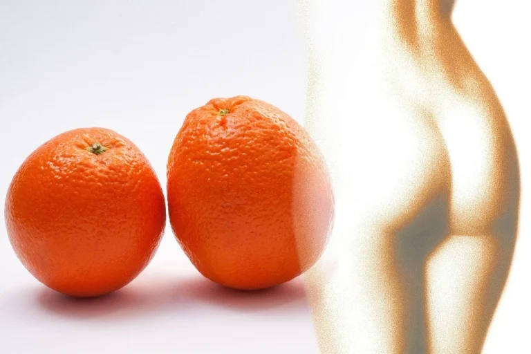 remedii celulita picioare